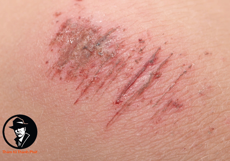 phải làm gì khi lòng đã có vết xước